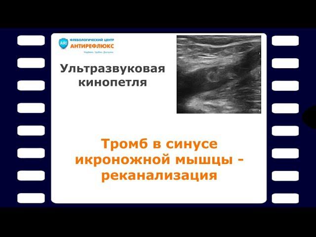 Тромб в синусе икроножной мышцы - реканализация смотреть онлайн