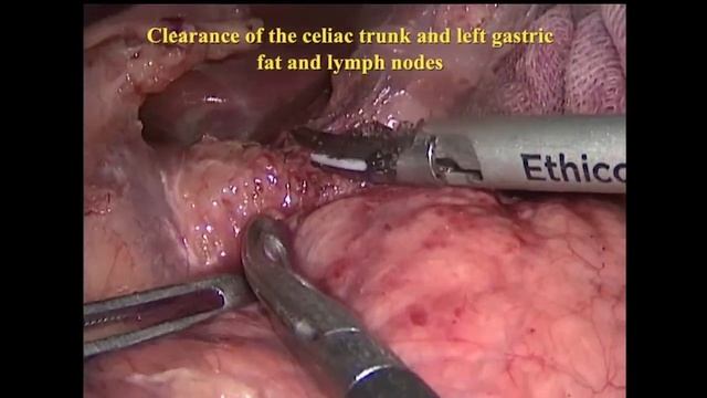Asvide: Minimally invasive McKeown esophagectomy with twofield lymph node dissection and manual... смотреть онлайн
