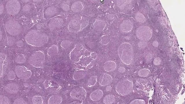 Histopathology Lymph node --Follicular lymphoma, grade 2 смотреть онлайн