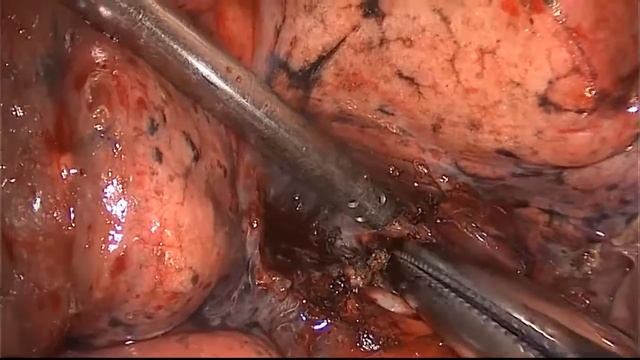 Asvide: Three portal VATS lobectomy complicated with sever hilar and interlobar inflammatory and... смотреть онлайн