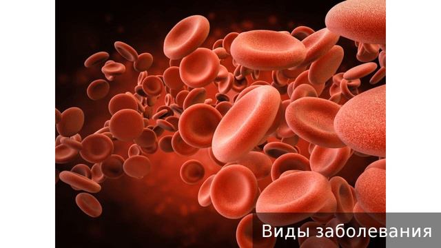 Полицитемия истинная. Как лечить полицитемию истинную. смотреть онлайн