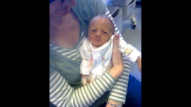 Эдвардс синдром Лучший Варианты лечения