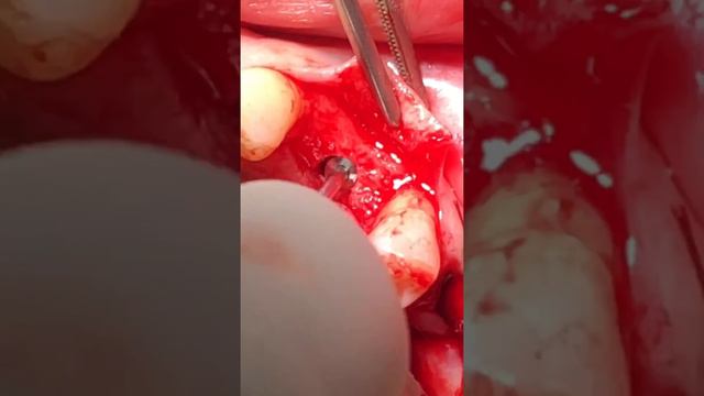 Implant placement 24 смотреть онлайн