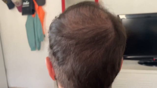 Пересадка волос результат от 3 до 6 месяцев смотреть онлайн