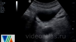 Дивертикулы мочевого пузыря