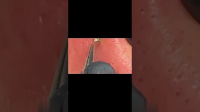 Giant Pimple & Popping Huge Blackheads Best Pimple Popping 01