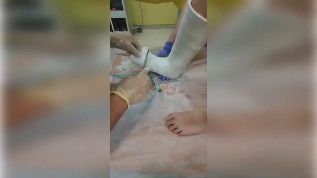 Как происходит гипсование?