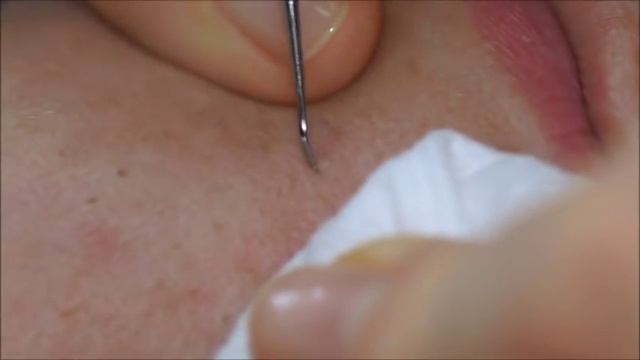 Мультикислотный пилинг смотреть онлайн