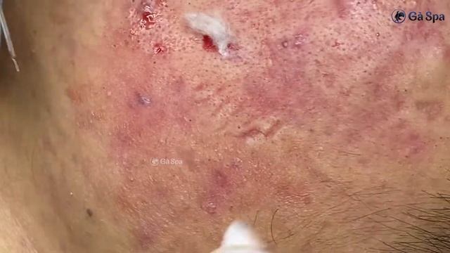 Acnes Treatment  2 #003