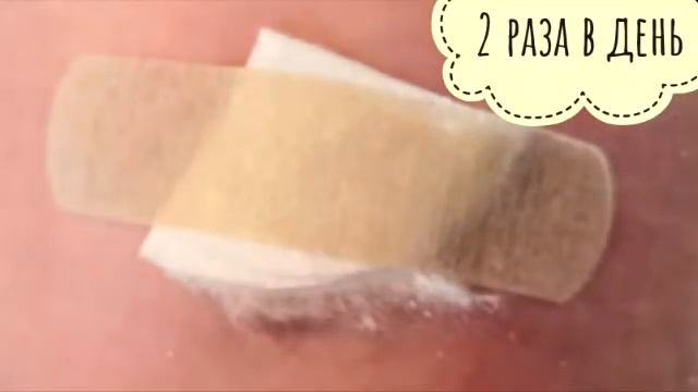 Фунгус (гранулёма пупка), омфалит. Пупок, новорожденный.