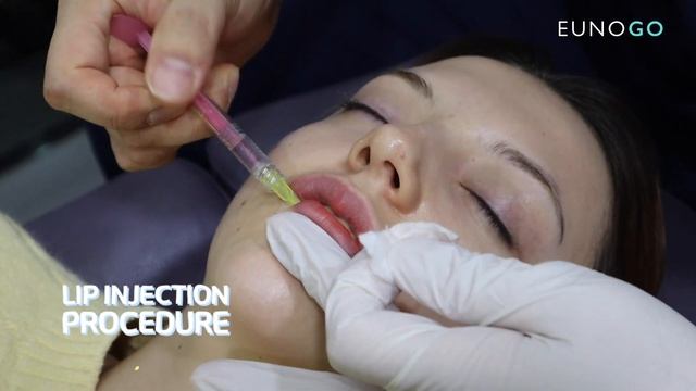 Getting Lip Fillers And Lip Corner Lift In Korea | How It's Like | Before & After  | Eunogo Beauty