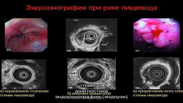 Эндосонография пищевода смотреть онлайн