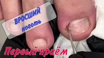 💥Вросший ноготь _ 💥врастающий ноготь _ 📍подолог Москва