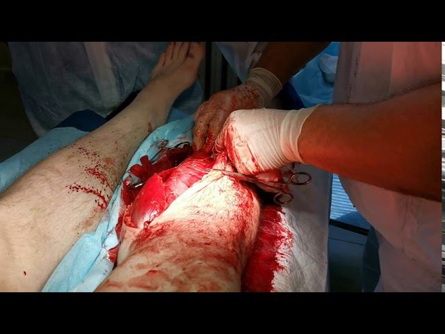 синдром позиционного сдавления