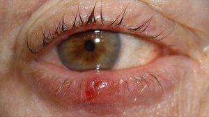 Как быстро избавиться от ячменя?