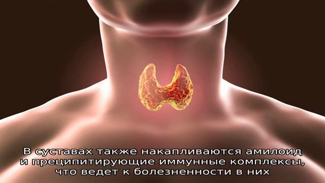 Паранеопластическая нефропатия смотреть онлайн
