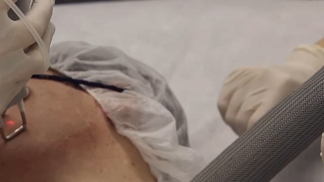 Лазерная шлифовка или ресурфейсинг смотреть онлайн