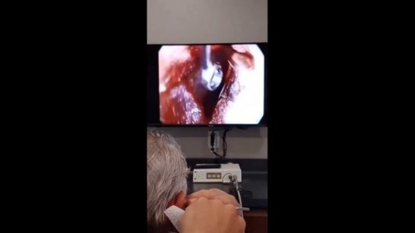 Професcиональная чистка ушей! Жесть!