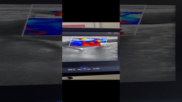 Тазовый варикоз у девушки. Варикоз на ногах. Узи вен. Флеболог Москва. Флеболог смотреть онлайн