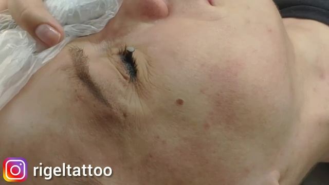 Защитные шильды для век | Лазерное удаление перманетного макияжа век | Лазерное удаления татуажа ве смотреть онлайн