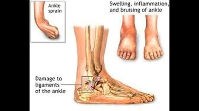 Wie zur Behandlung und Heilung Xanthogranulomatöse Osteomyelitis смотреть онлайн