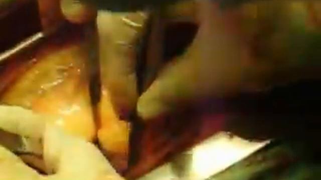 pierre ,tumor cardiaco extraccion смотреть онлайн