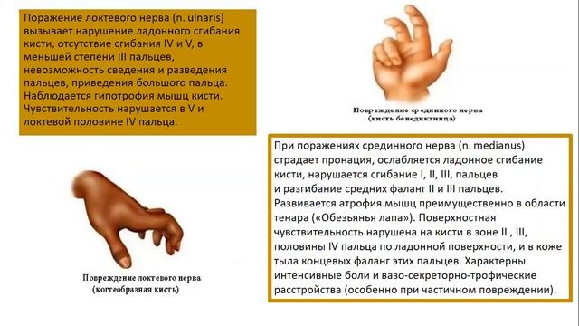 Травмы нервов верхней конечности смотреть онлайн