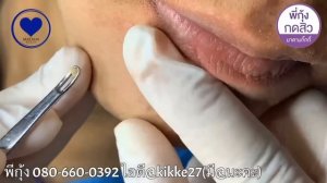 Выдавливание чёрных точек НОВОЕ! Чистка лица. Удаление и выдавливание прыщей. Лечение акне