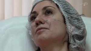Увеличиваем объем скул канюлей