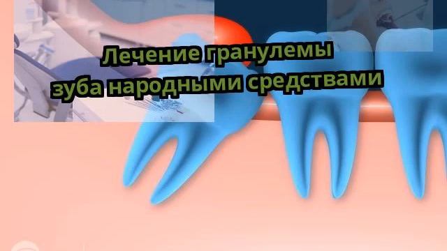 Лечение гранулемы зуба народными средствами смотреть онлайн