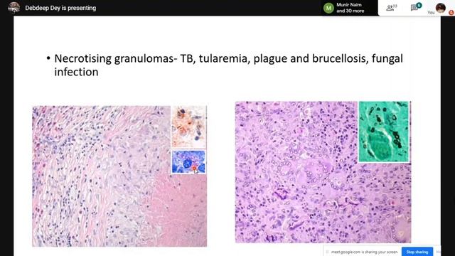 Pursue 2A (Uploaded): Pattern Based Approach to Lymph Nodal Lesions смотреть онлайн