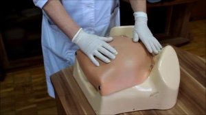 Способы выделения отделившегося последа