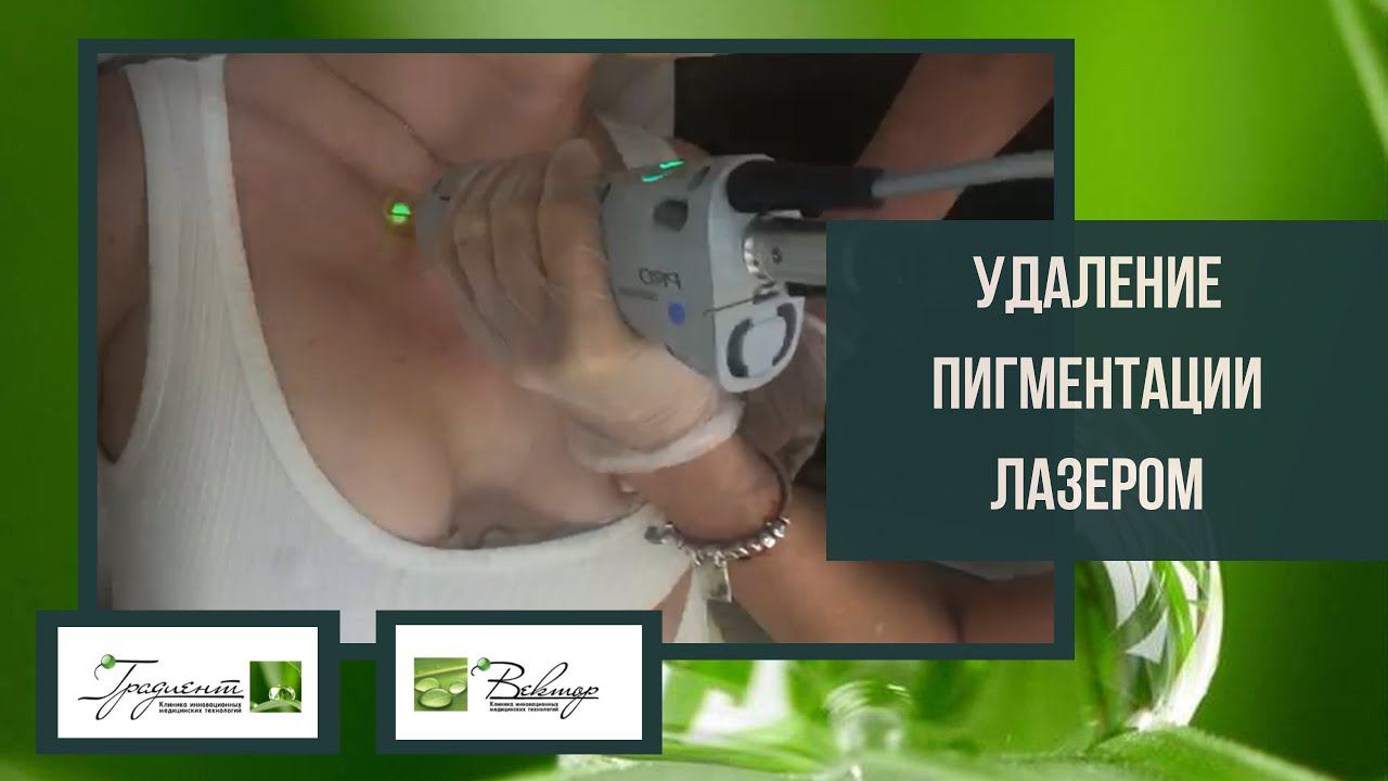 Удаление пигментации и омоложение зоны декольте лазером - на аппарате Candela GentleLase смотреть онлайн