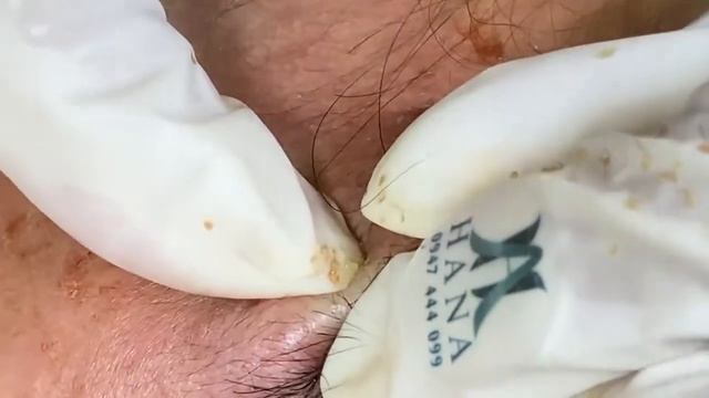 Relaxing Acne Treatment Acnes Treatment  99