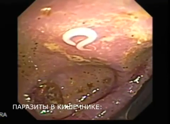 Глисты у человека (паразиты, гельминты) - симптомы у ребенка, признаки у взрослого - лечение глистов
