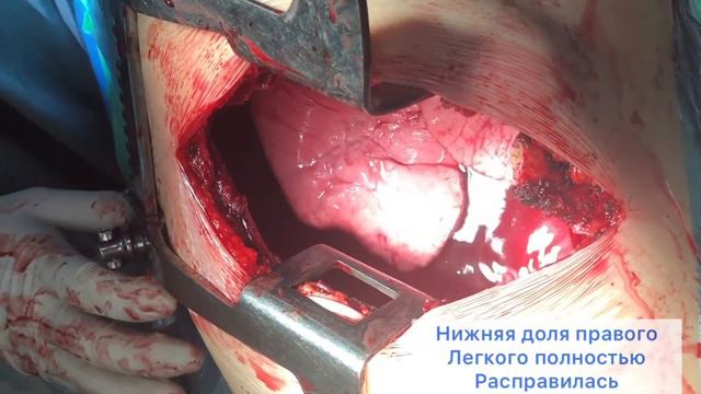 Гигантская солитарная фиброзная опухоль плевры справа (РНЦХ) смотреть онлайн