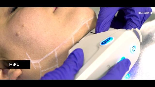 HIFU – Апарат за ултразвуков лифтинг на лице
