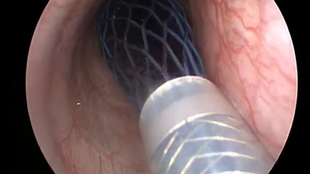 Стентирование трахеи у собаки Эндовет Курган www.endovet.su смотреть онлайн