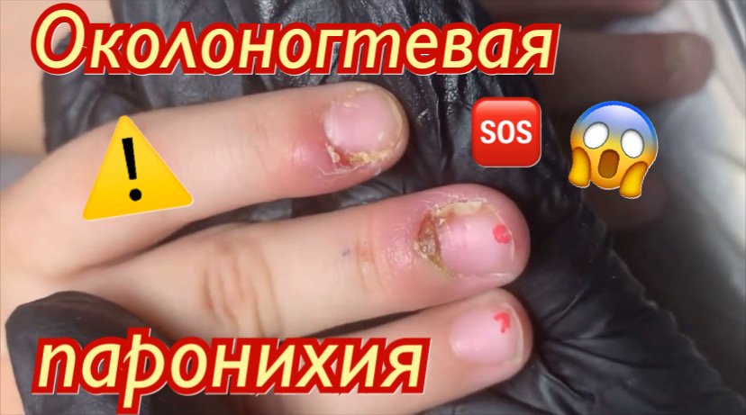 Околоногтевая паронихия??⚠️? смотреть онлайн