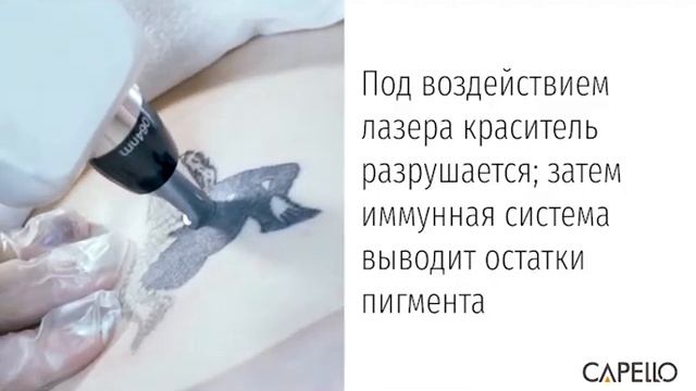 Удаление татуировок на неодимовом лазере смотреть онлайн