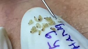 ОГРОМНЫЕ прыщи и ЧЁРНЫЕ точки | РЕЛАКС видео | Выдавливание прыщей и камедонов