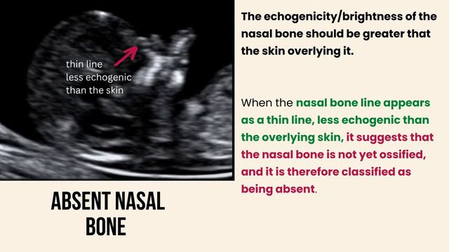 Ultrasound Pregnancy Nasal Bone. Absent, present or short nasal bone. How to identify? смотреть онлайн