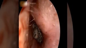 Паразиты в носу ребенка. Вытащить червей-лярв из носа девочки. Паразиты внутри тела.