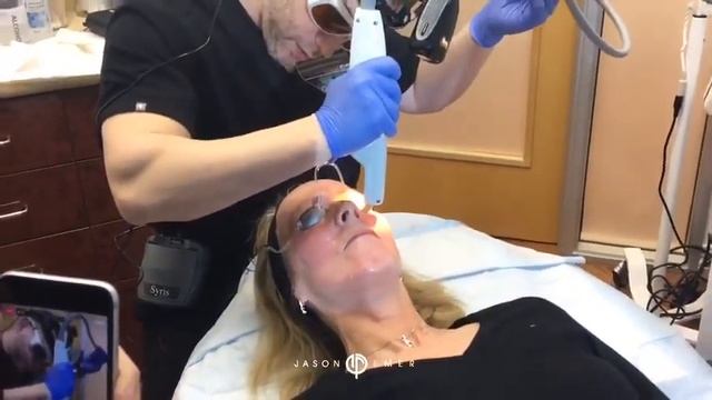 Treating Rosacea with Lasers | Aerolase, Excel V and Clear + Brilliant | Live смотреть онлайн