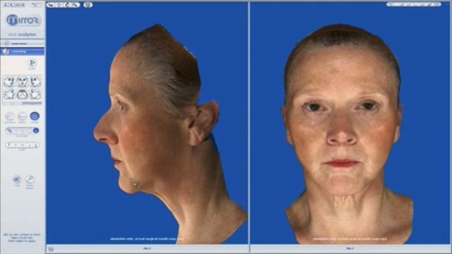 VECTRA Lifting 3D смотреть онлайн
