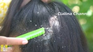 Long Hair Combing, Extreme Damage - Dandruff Shampoo and Huge Flake Scratching #791
