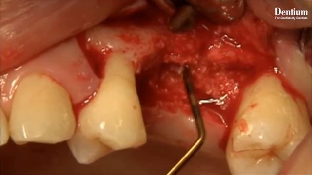 DASK  Crestal Approach Sinus Lift With Sinus Balloon