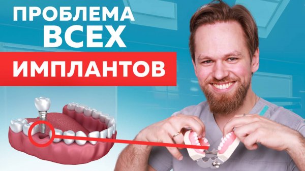 ВСЁ про зубные ИМПЛАНТЫ (цена, установка имплантов зубов, гарантия)