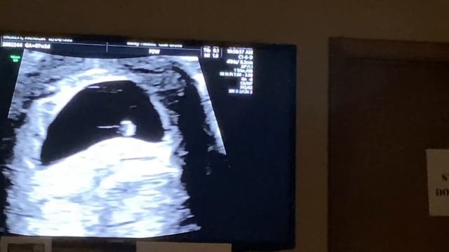 7 Weeks (FIRST ULTRASOUND) I HAVE NEVER BEEN SO SCARED IN MY LIFE! Seeing baby for the first time! смотреть онлайн