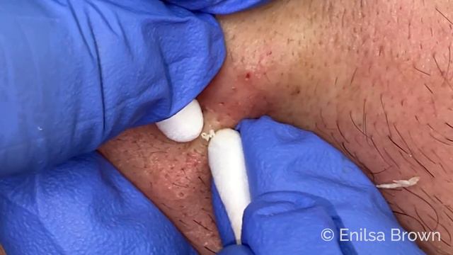 Blackhead & Whitehead Extractions on "K" - Part 2 смотреть онлайн